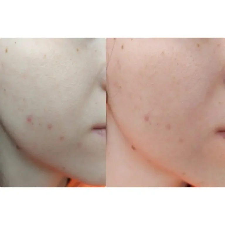 Spot The Difference Blemish Treatment